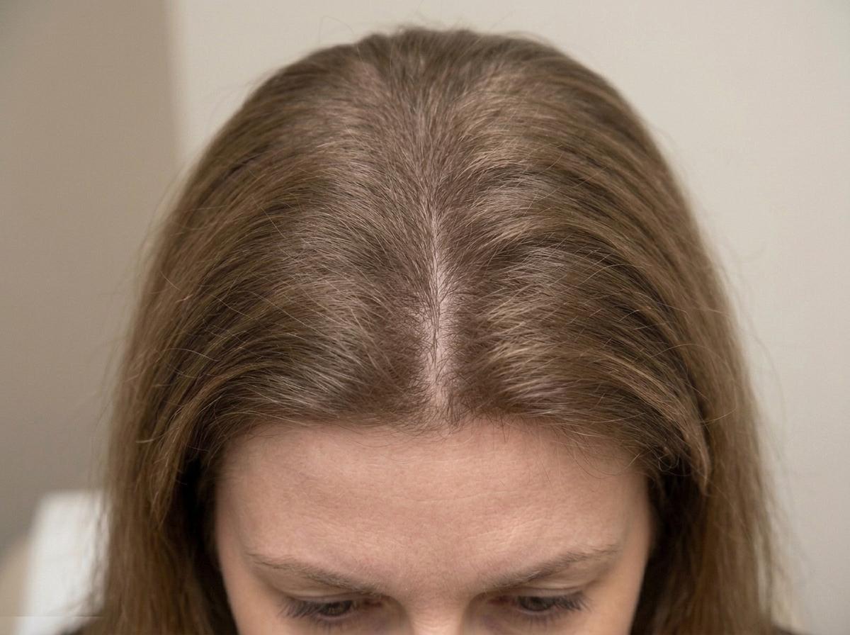 Post-Treatment Regrowth (12 Weeks Protocol - Dense Follicular Recovery)